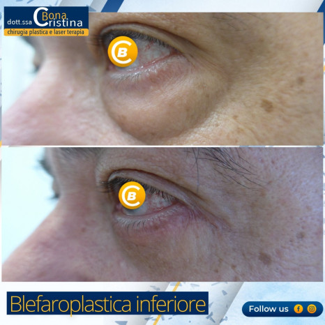 Blefaroplastica prima e dopo |Dott.ssa Cristina Bona